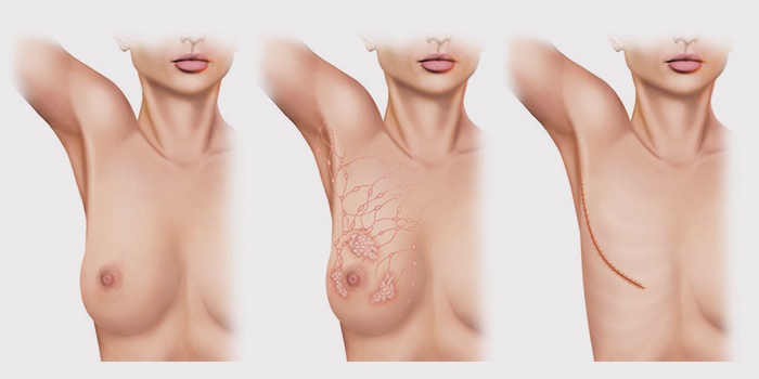 Рак грудины у женщин лечение 26