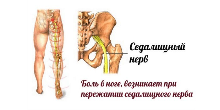 Боль в ноге при ущемлении седалищного нерва