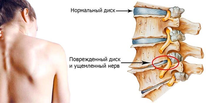 Поврежденный диск и ущемленный нерв шейного отдела