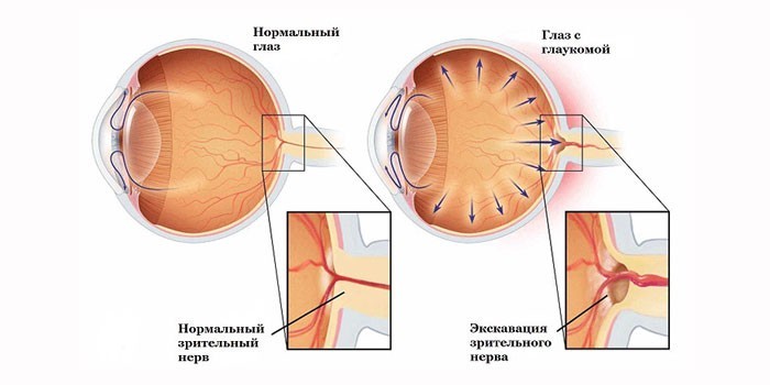 Глаукома глаз