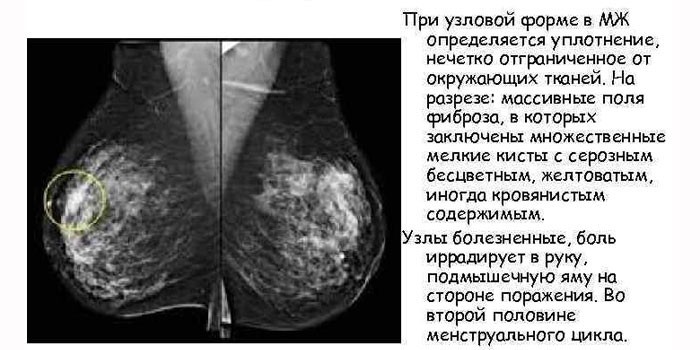 Проявления узловой формы на маммографии