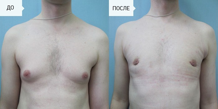 Фото до и после масэктомии