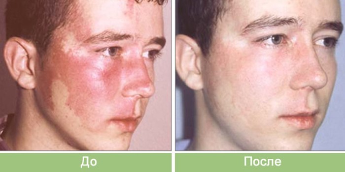 До и после лечения лазером