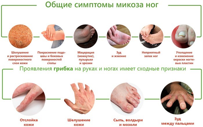 Симптоматика микозов рук и ног