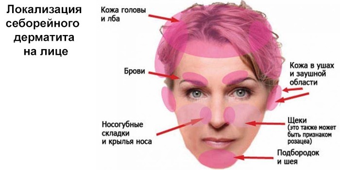 Локализация себорейного дерматита на лице