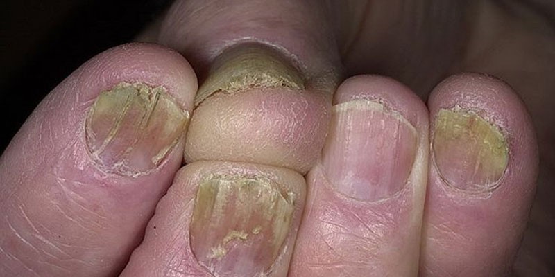 Грибок ногтей название заболевания 18