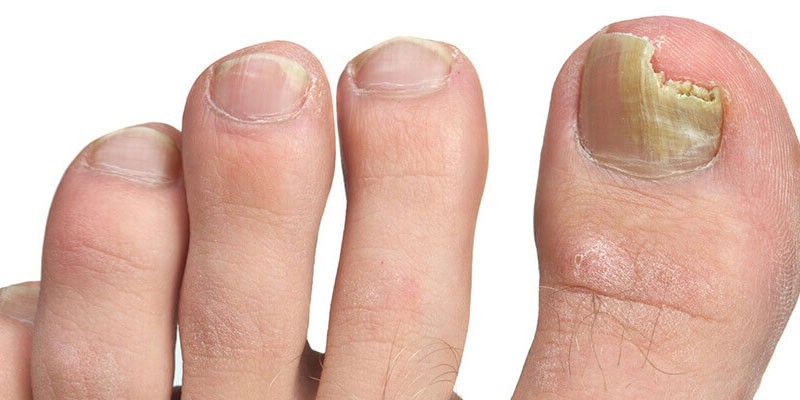 Грибок ногтей название заболевания 19