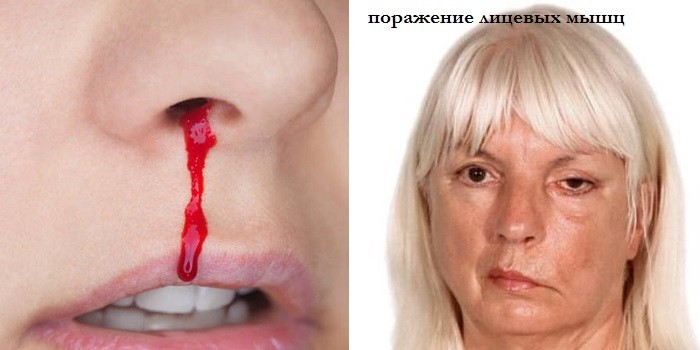 Носовое кровотечение и поражение лицевых мышц