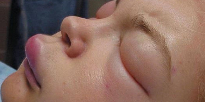 Проявления аллергического отека на лице