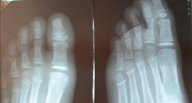 Рентген перелома пальца ноги