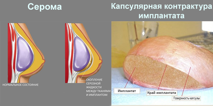Серома и капсулярная контрактура имплантата 