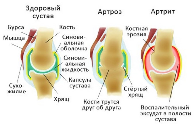 Артроз и артрит на схеме