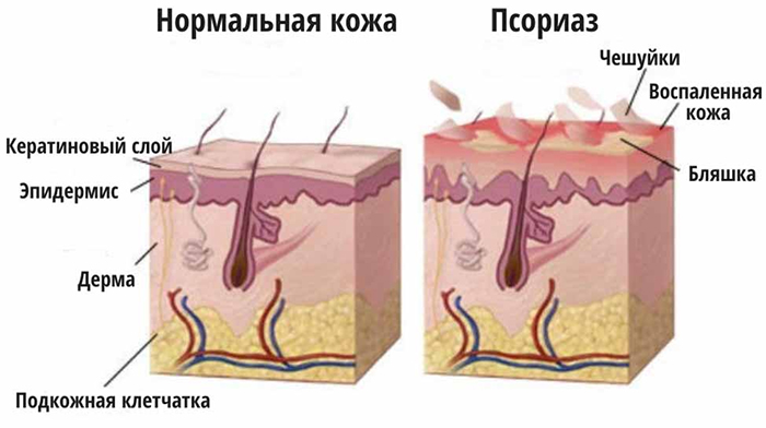 Здоровая кожа и псориаз