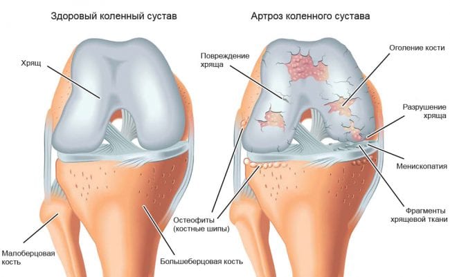Артроз коленного сустава на схеме