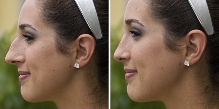 Нос до и после ринопластики