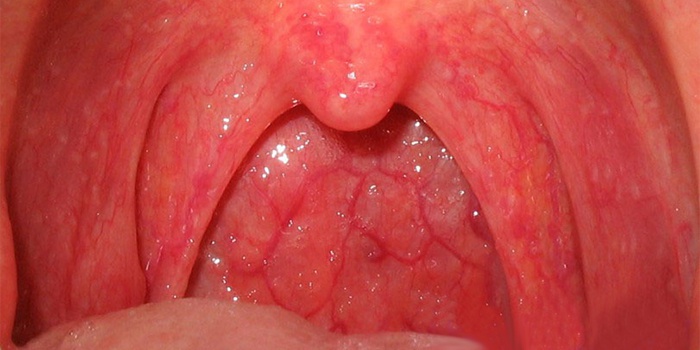 Вирусное заболевание горла