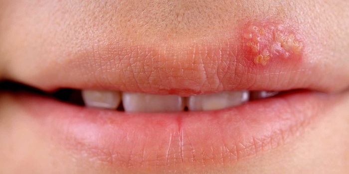 Проявления вируса герпеса на верхней губе