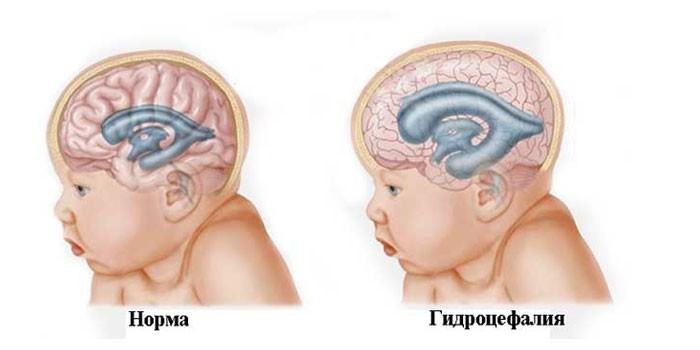 Норма развития головного мозга и гидроцефалия у новорожденного