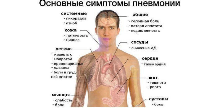 Основные симптомы пневмонии