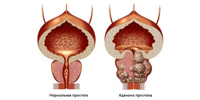 Нормальная простата и аденома