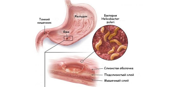 Желудок и бактерия Хеликобактер пилори