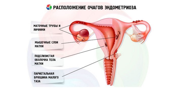 Расположение очагов эндометриоза