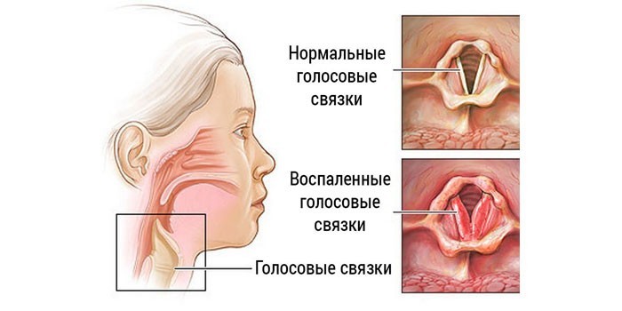 Воспаление голосовых связок