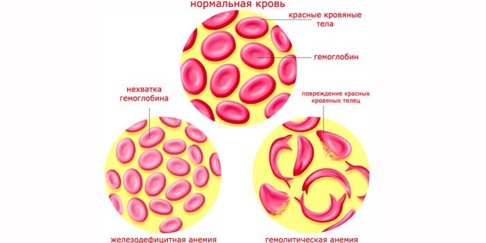 Гемолитическая и железодефицитная анемия