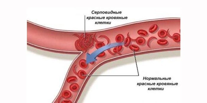 Нормальные и серповидные красные кровяные клетки 