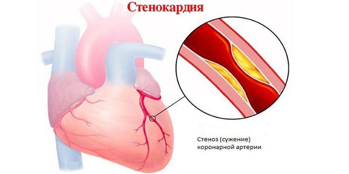 Стеноз коронарной артерии