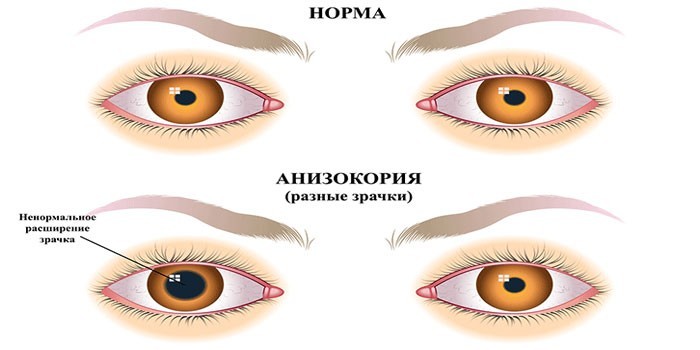 Анизокория глаз