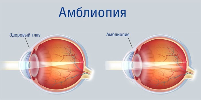 Амблиопия глаза