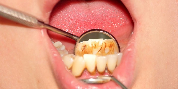 Зубной камень на зубах нижней челюсти
