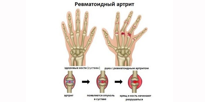 Проявления ревматоидного артрита