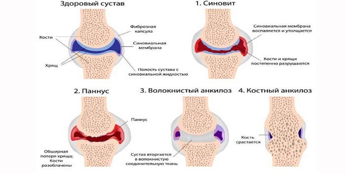 Стадии ревматоидного артрита