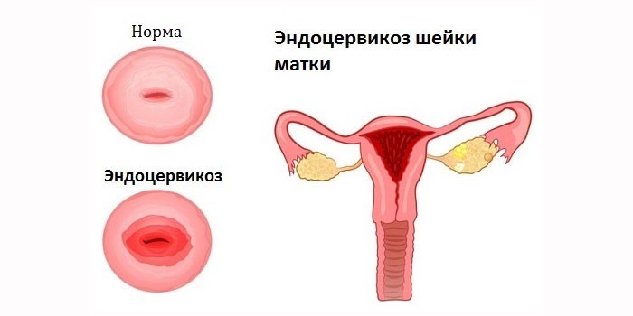 Нормальная шейка матки и пораженная эндоцервикозом