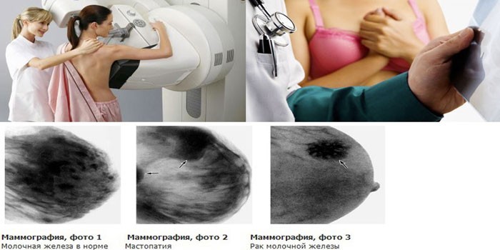 Проведение и результаты маммографии