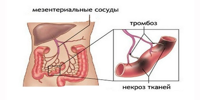 Некроз тканей кишечника