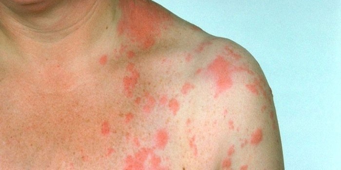 Инфекционные поражения кожи