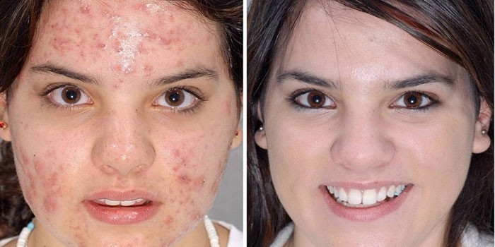 Фото девушки до и после химического пилинга