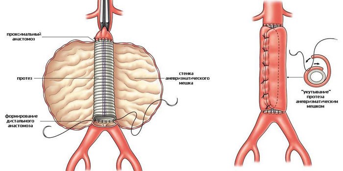 Аневризма брюшной аорты до и после операции