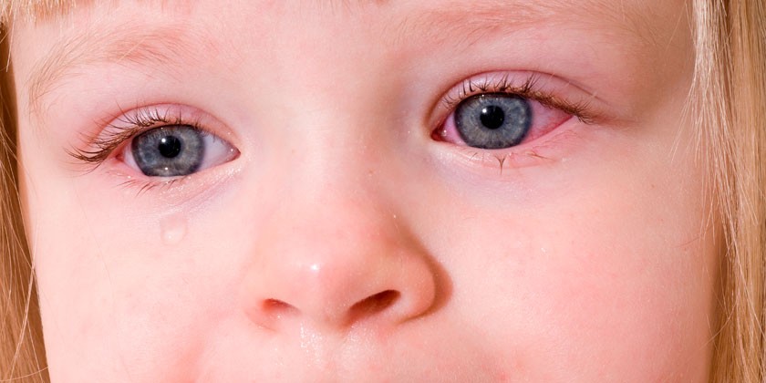 Покраснение глаз у ребенка
