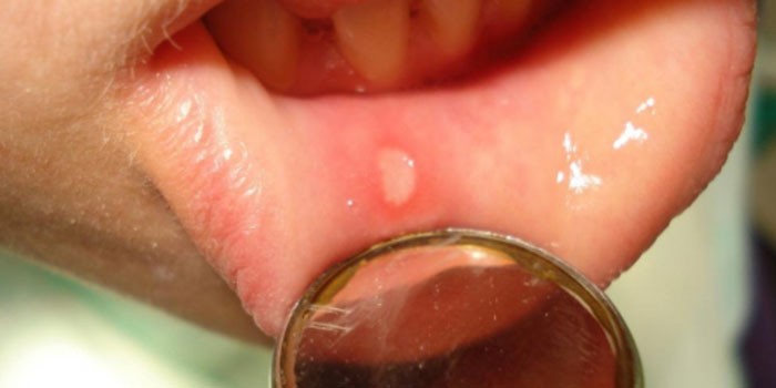 Стоматит на губе у ребенка