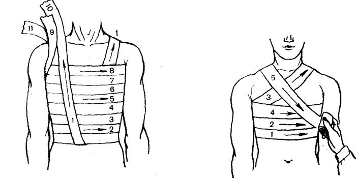 Схем наложения фиксирующей повязки на грудь.