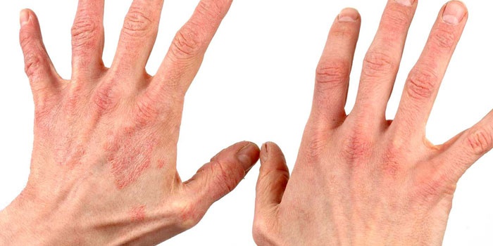 Кожа рук пораженная микозом