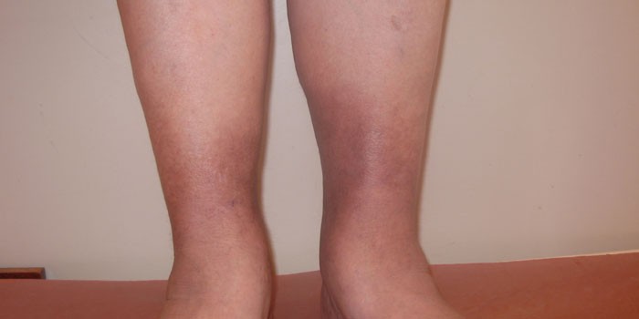 Проявления хронической венозной недостаточности на ногах