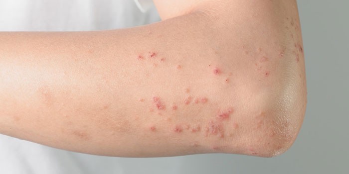 Проявление аллергической реакции на коже руки