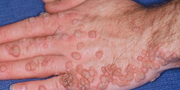 Вирус папилломы на руке