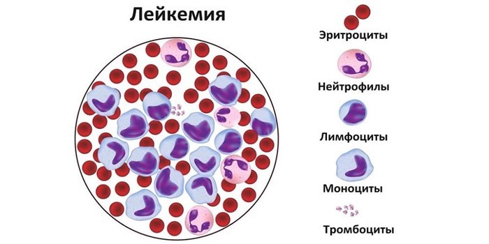 Клетки при лейкемии