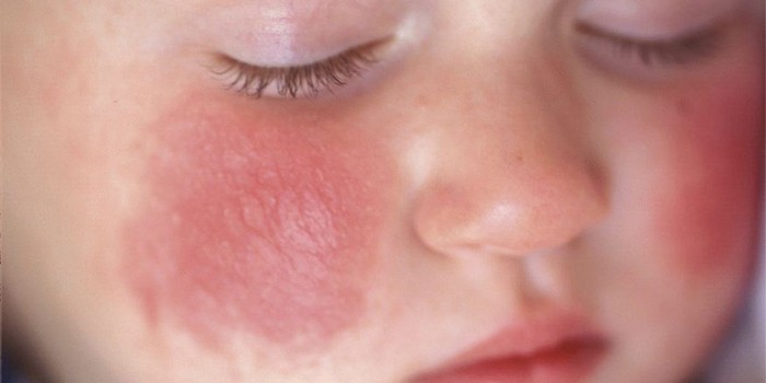 Проявления заболевания на лице у малыша